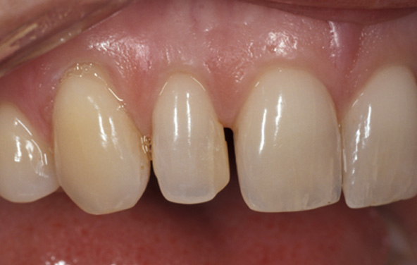 PG-BondingFilling-5a