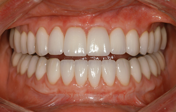 PG-Crowns-13b