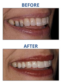 CD-veneers2