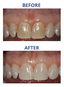 CD_Whitening