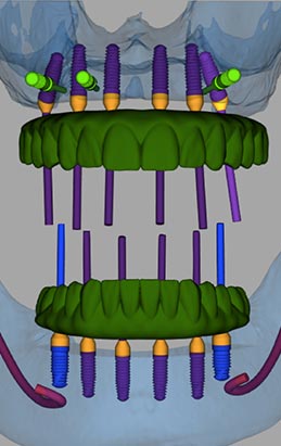 All-On-4_5-middle